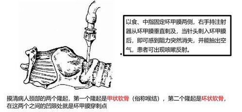 环甲膜穿刺术操作视频